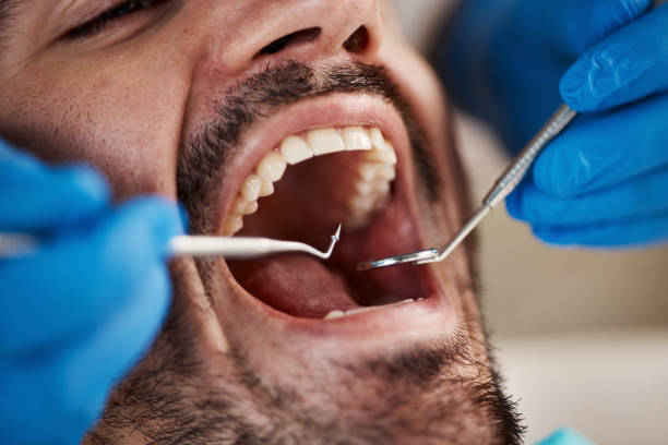 Best Emergency Tooth Extraction in Silver Firs, WA